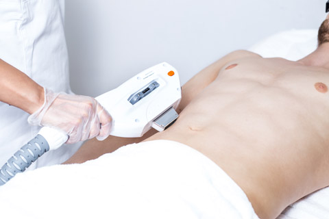 Behandlung der dauerhaften Haarentfernung am Bauch mit Laser/SHR/IPL.