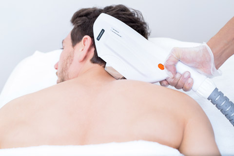 Behandlung der dauerhaften Haarentfernung im Nacken mit Laser/SHR/IPL.